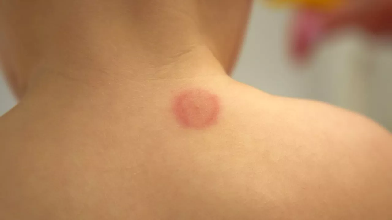 The Bullseye Warning: Navigating the Rising Lyme Disease Threat in the UK