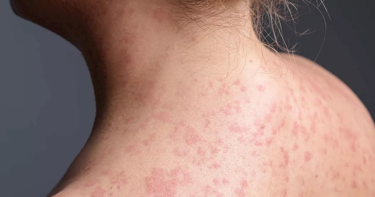 The Return of the Red Rash: Why Measles is Breaking Through North American Defenses