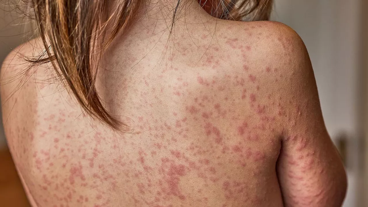 The 60% Risk Spike: How Childhood Fevers May Trigger Eczema