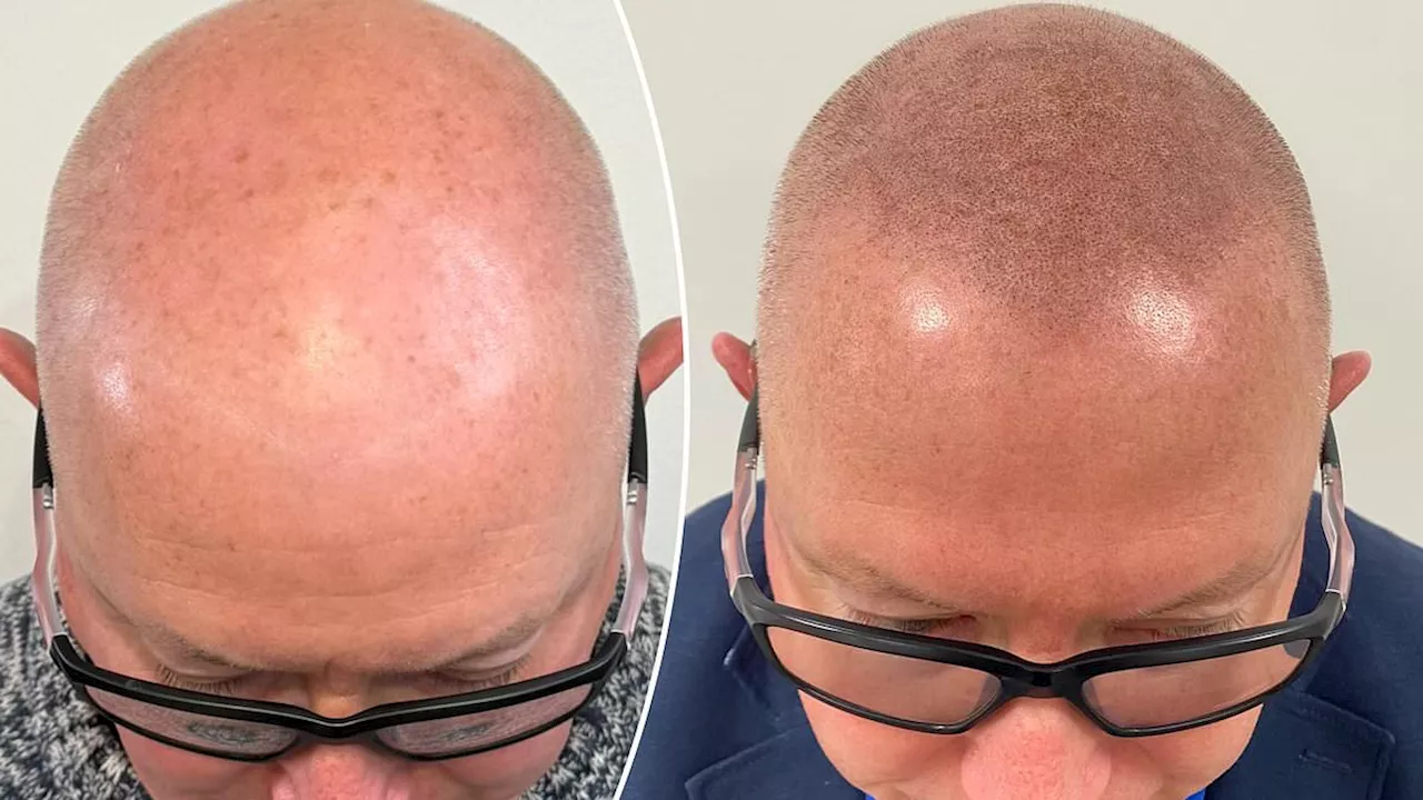 The Tattooed Hairline: Why UK Men are Swapping Surgery for Scalp Micropigmentation