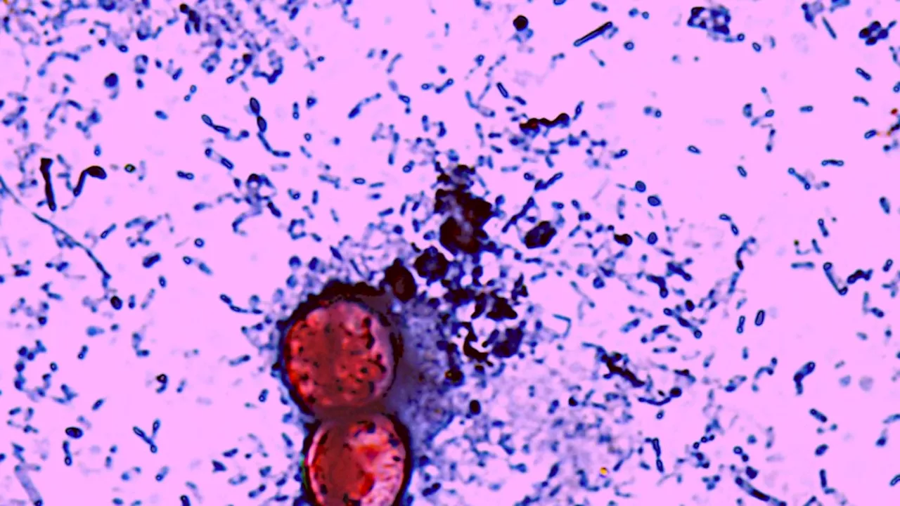 The 2026 Cyclosporiasis Surge: Deaths and the Cost of CDC Budget Cuts