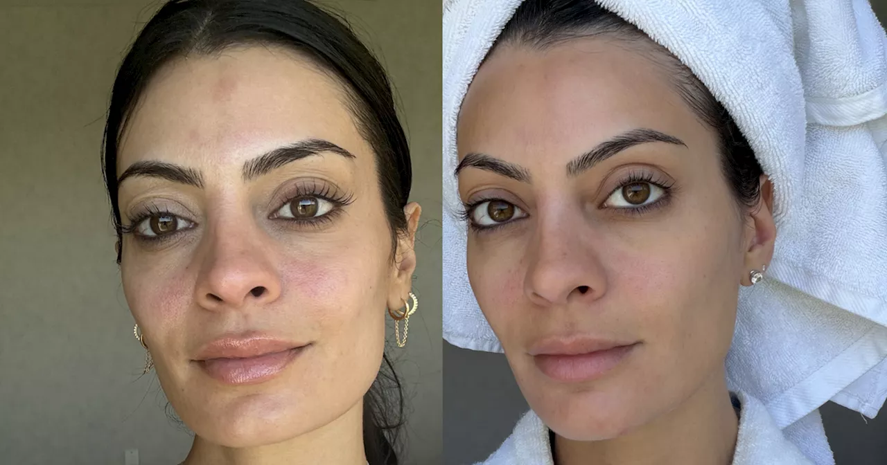 Beyond Green Primers: Why Azelaic Acid is Winning the Battle Against Facial Redness