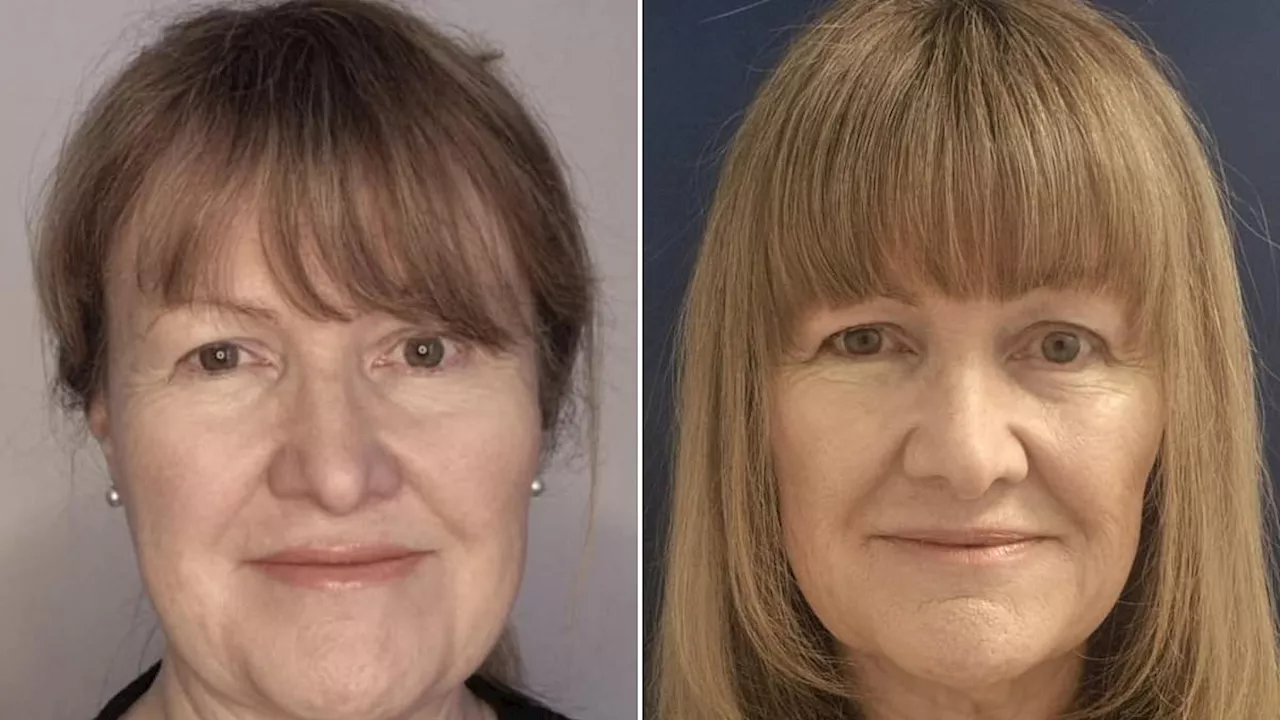 Beyond Vanity: How a £400 Filler Treatment Helped a Welsh Widow Reclaim Her Identity