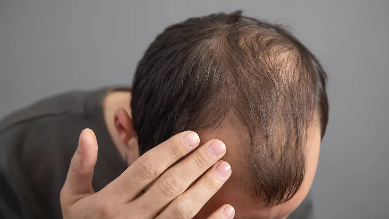 Beyond Arthritis: Upadacitinib Shows Potential to Reverse Severe Hair Loss