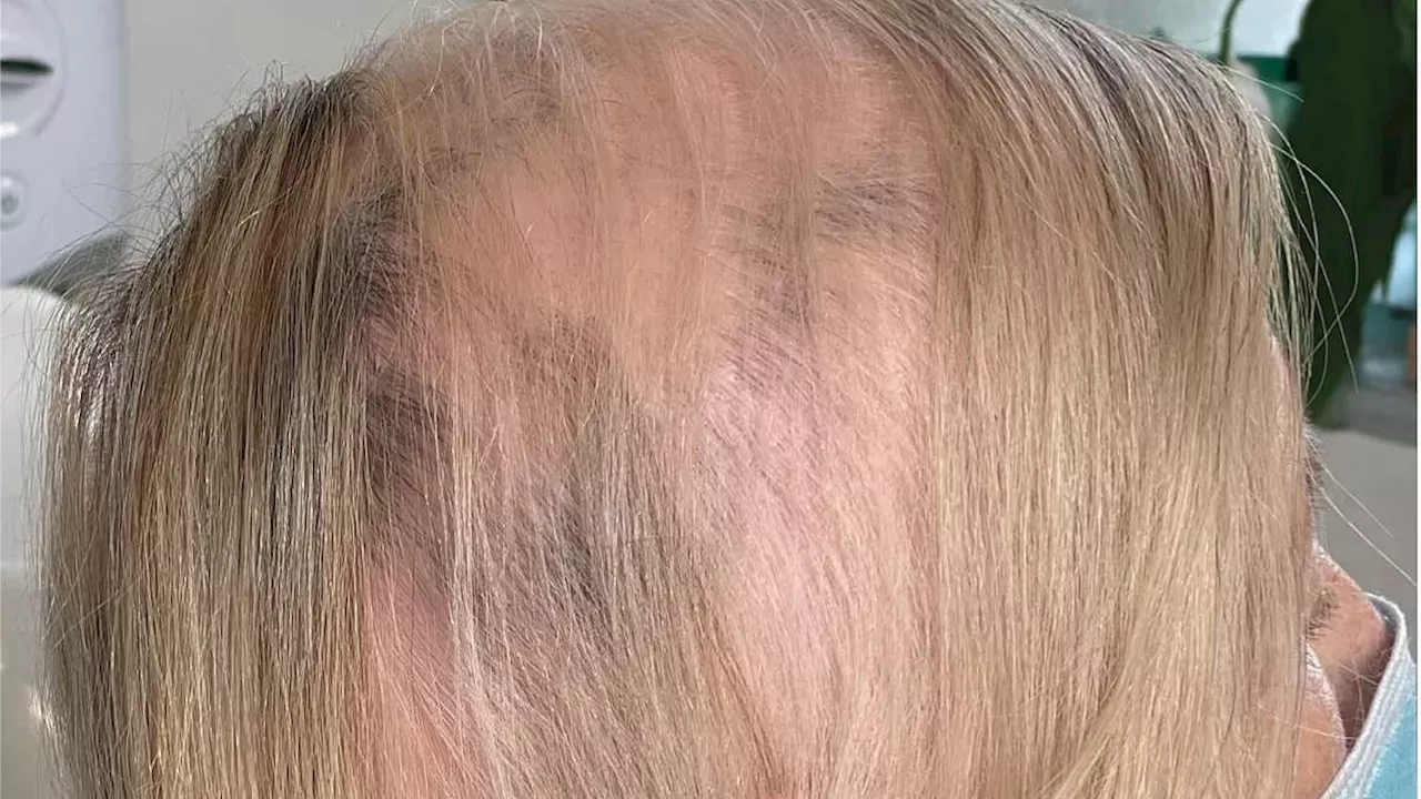 Beyond the Wig: How a 75-Year-Old Found Relief from 11 Years of Alopecia