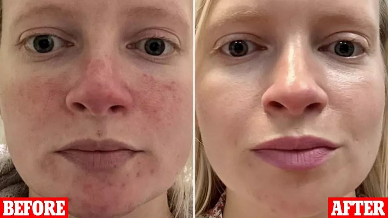 From Grain to Glow: The Rise of Azelaic Acid in Mainstream Skincare