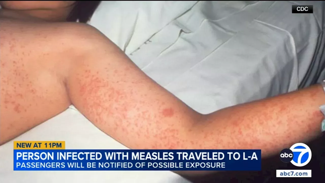 A Four-Hour Window of Risk: The Measles Exposure at LA Union Station