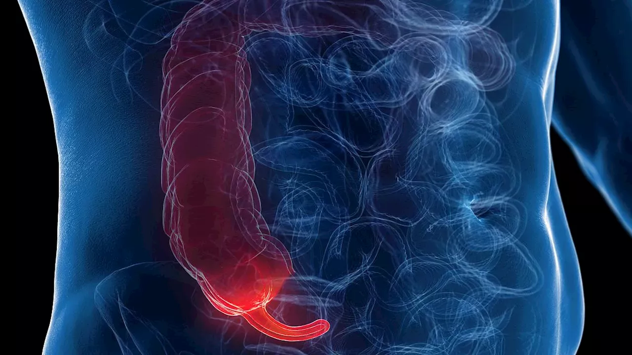 Appendix Cancer Rates Surge Among Younger People Globally