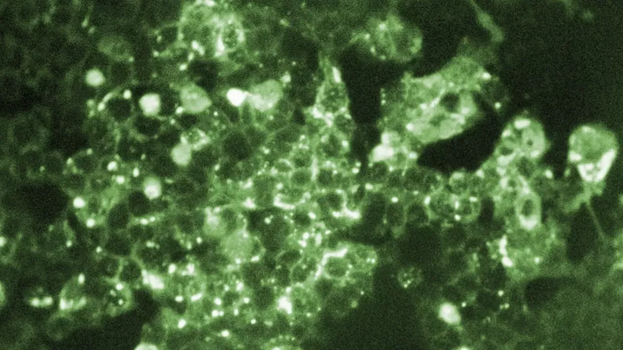 Pennsylvania’s Measles Crisis: 5 Deaths and a Growing 943-Case Outbreak
