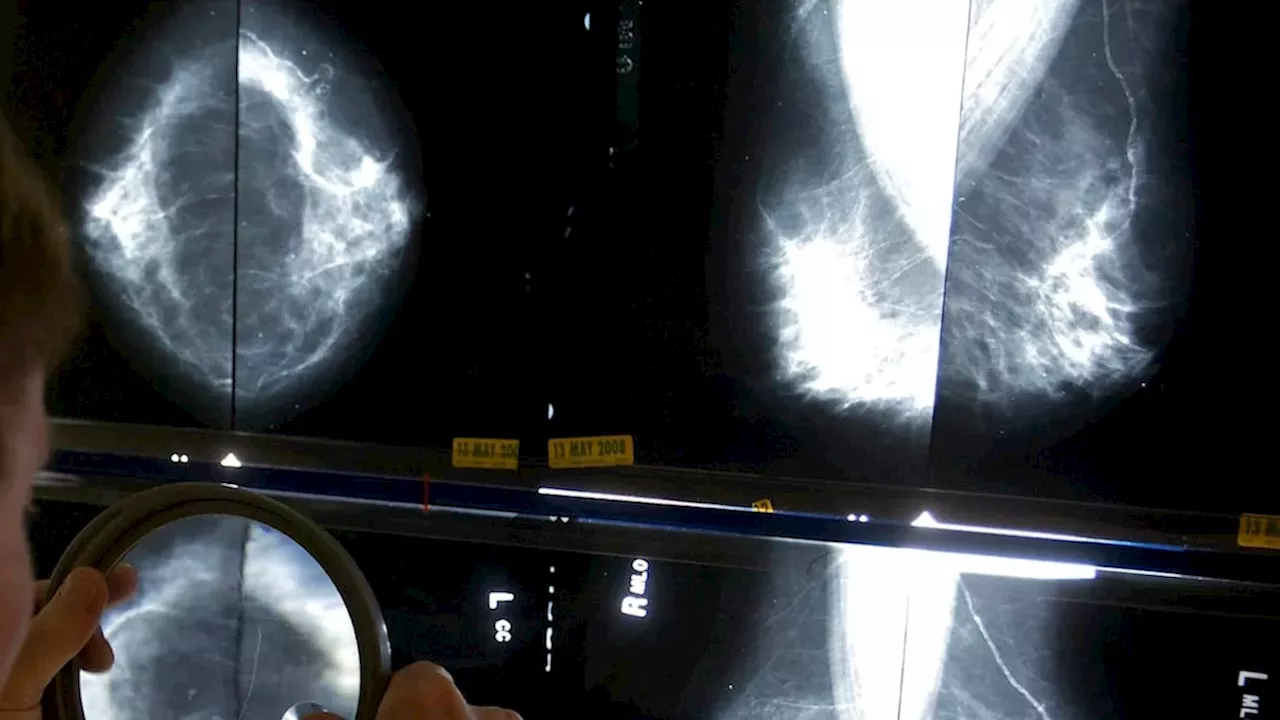 Standardizing Survival: The Massive Public Push for National Breast Cancer Protocols