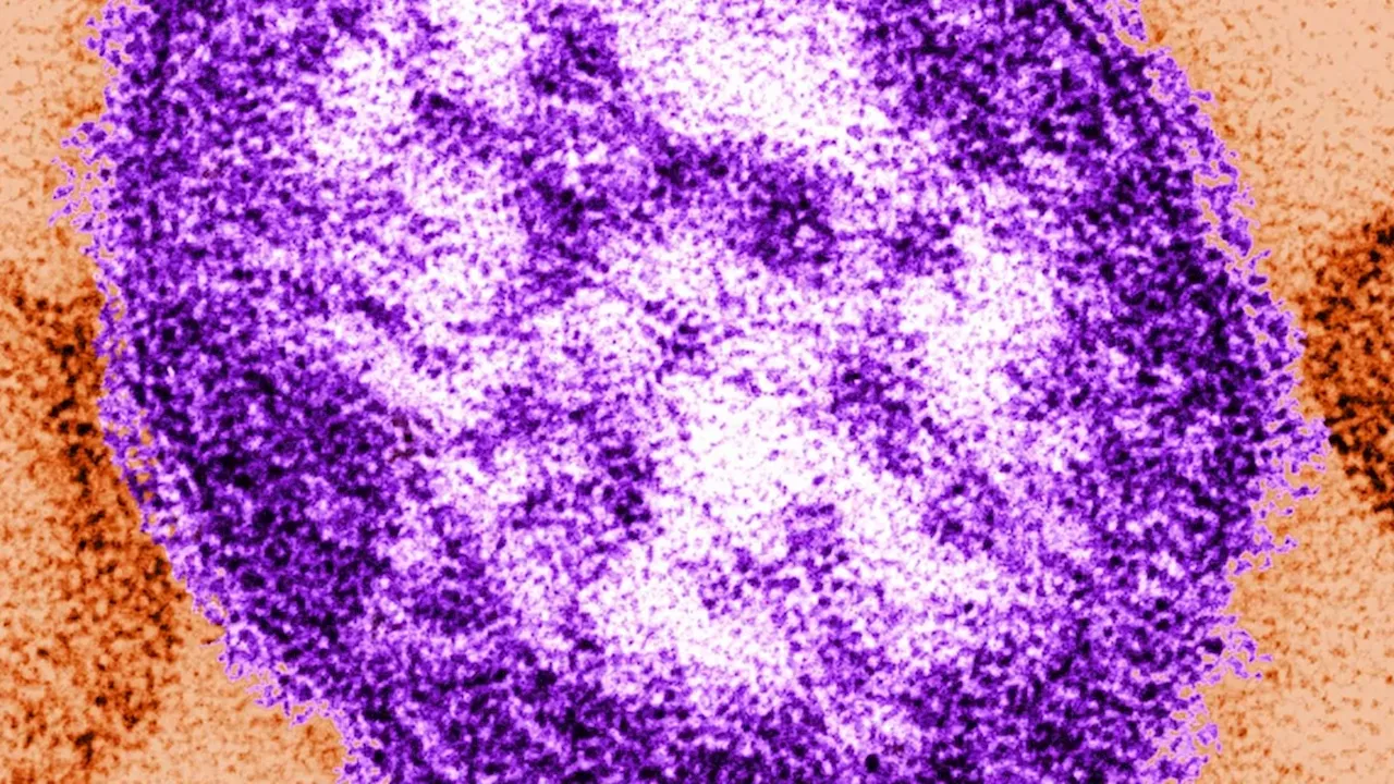 Ottawa Public Health warns of measles exposure at eight locations linked to two confirmed cases