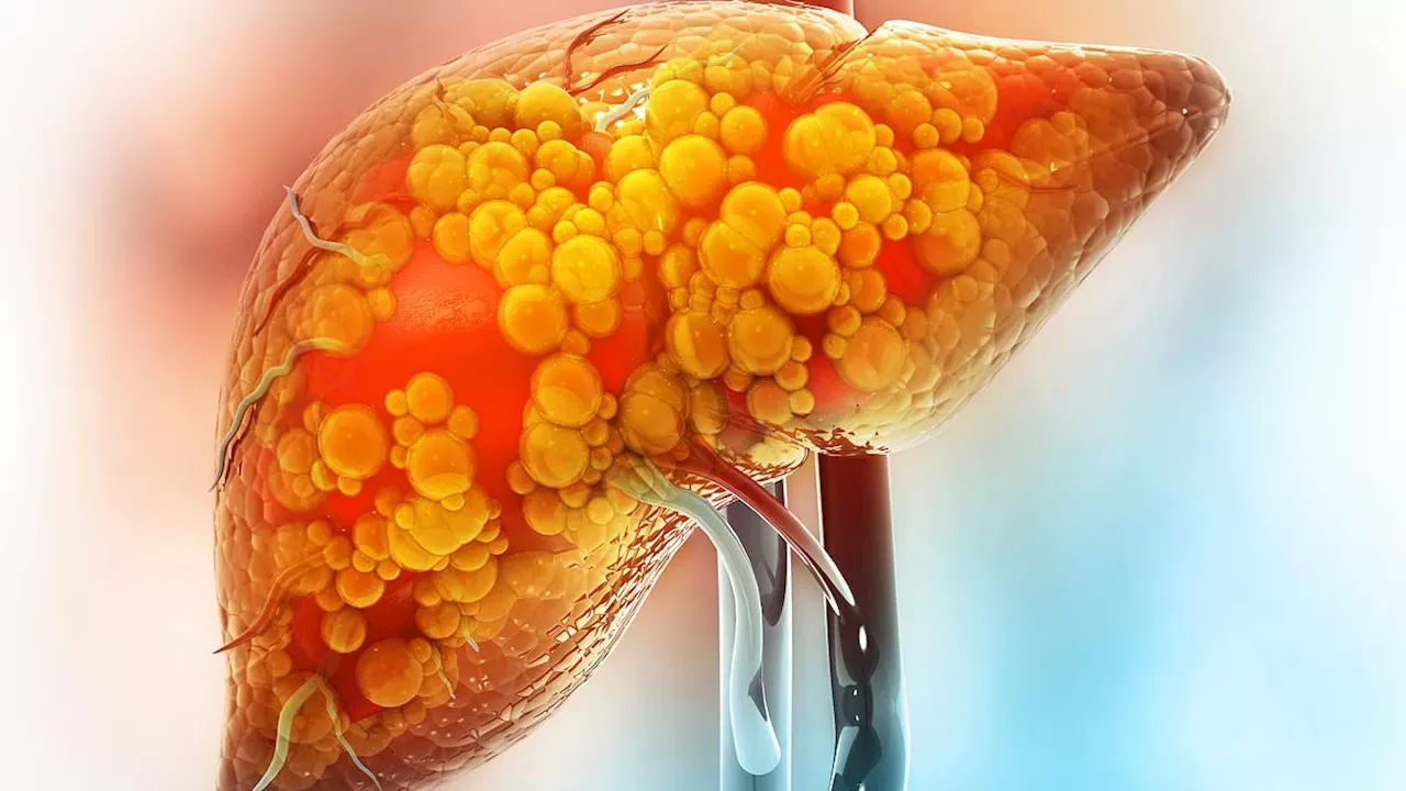 Beyond Alcohol: The Hidden Dietary Triggers Driving a 143% Surge in Liver Disease