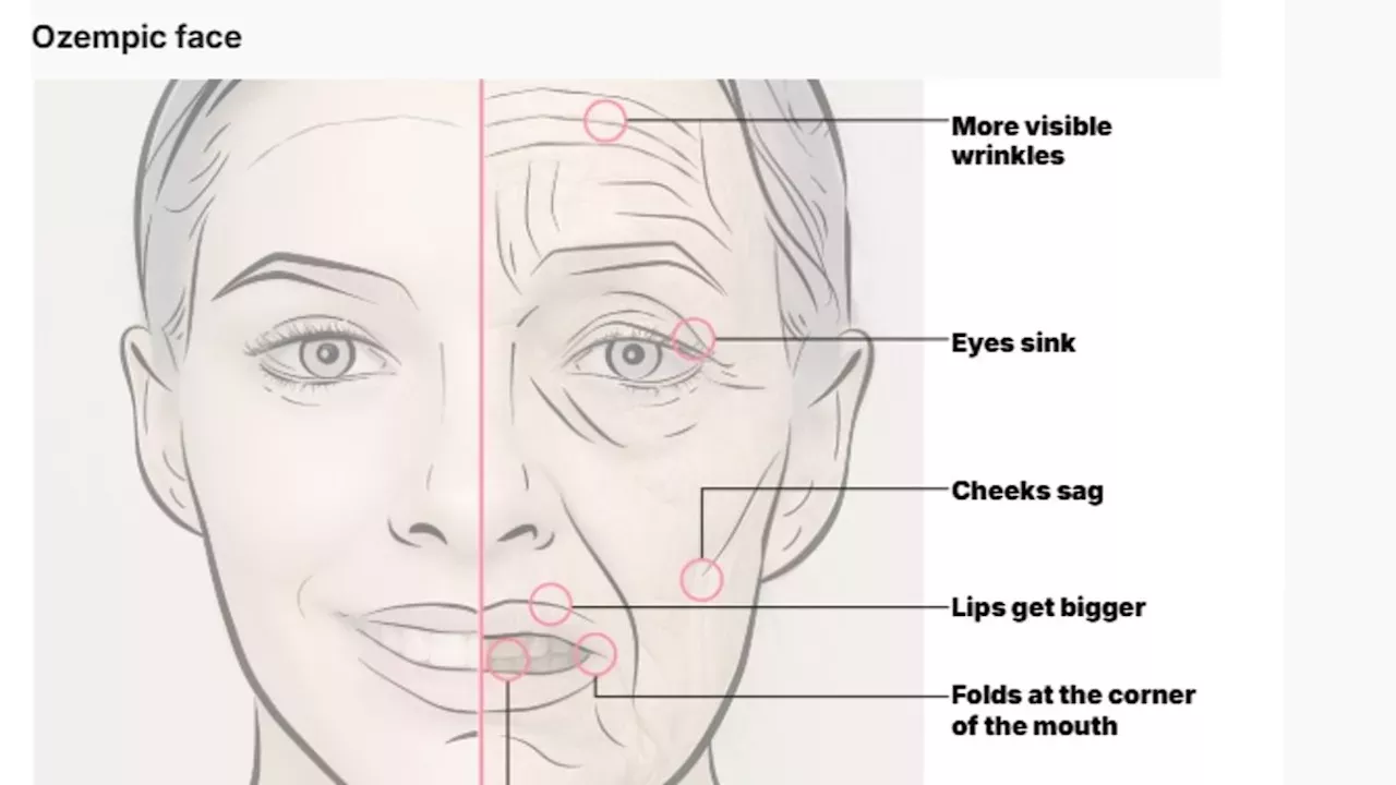 The 'Filler in a Bottle' Debate: Can Volufiline Truly Reverse Ozempic Face?