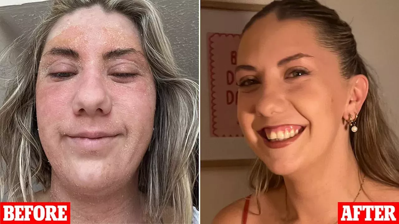 Beyond the Surface: Amy Watkins’ Journey from Skin Infection to Gut-Led Recovery